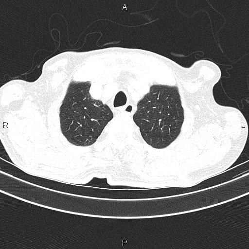 Ampullary adenocarcinoma (Radiopaedia 86093-102033 Axial lung window 18).jpg