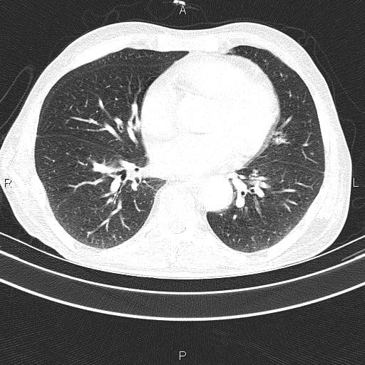 Ampullary adenocarcinoma (Radiopaedia 86093-102033 Axial lung window 38).jpg
