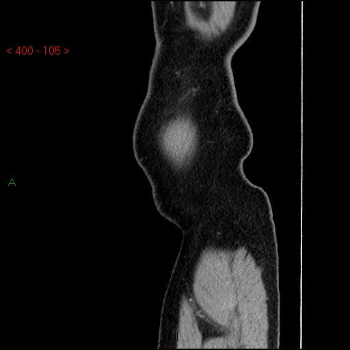 Ampullary carcinoma (Radiopaedia 56396-63056 D 104).jpg