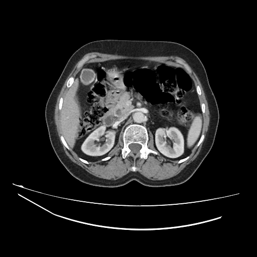 Ampullary tumor (Radiopaedia 60333-67998 A 27).jpg