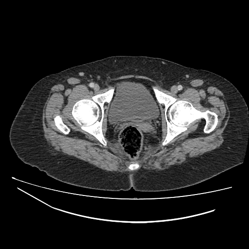 Ampullary tumor (Radiopaedia 60333-67998 A 89).jpg