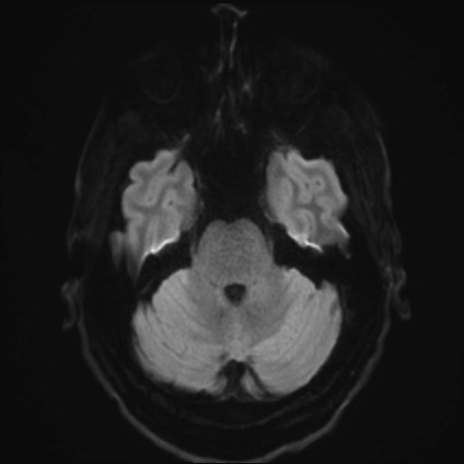Amyotrophic lateral sclerosis (Radiopaedia 87352-103658 Axial DWI 35).jpg