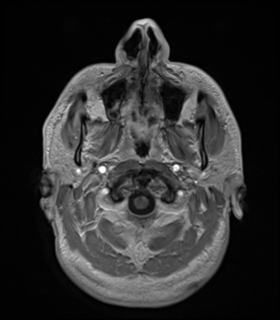 File:Anaplastic astrocytoma IDH wild-type (Radiopaedia 49984-55273 Axial T1 C+ 5).png