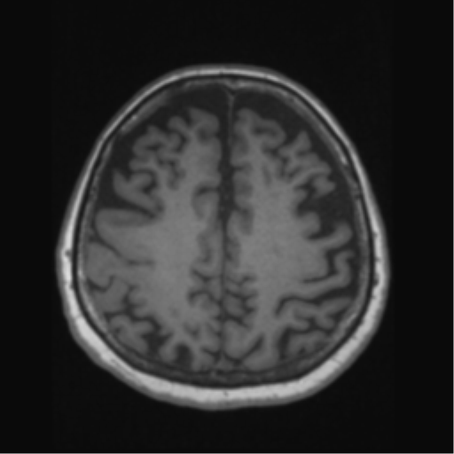 Anaplastic astrocytoma IDH wild-type (pseudoprogression) (Radiopaedia 42209-45276 Axial T1 109).png