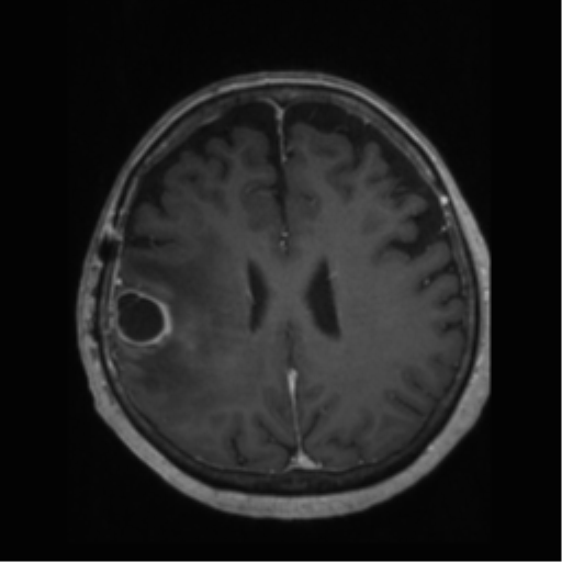 File:Anaplastic astrocytoma IDH wild-type (pseudoprogression) (Radiopaedia 42209-45277 Axial T1 C+ 82).png