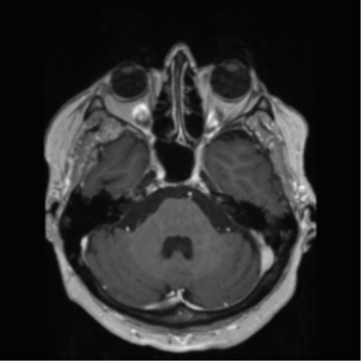 File:Anaplastic astrocytoma IDH wild-type (pseudoprogression) (Radiopaedia 42209-45278 Axial T1 C+ 51).png