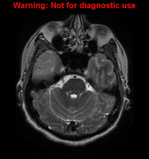 File:Anaplastic ganglioglioma (Radiopaedia 44921-48831 Axial T2 9).jpg