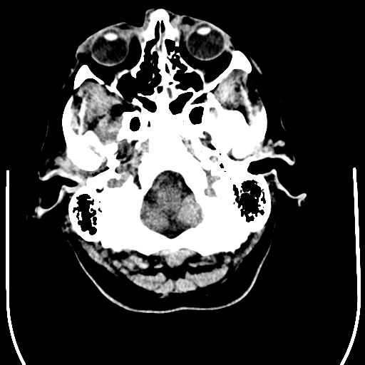 File:Anaplastic meningioma with recurrence (Radiopaedia 34452-35781 Axial non-contrast 4).png