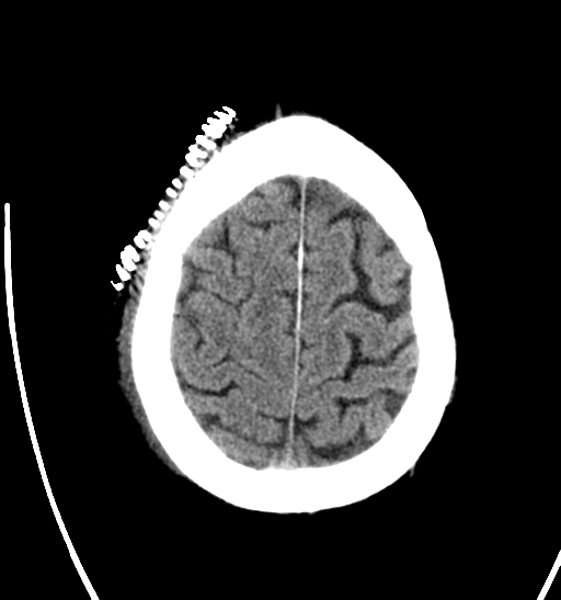 File:Anaplastic meningioma with recurrence (Radiopaedia 34452-35786 Axial non-contrast 27).png