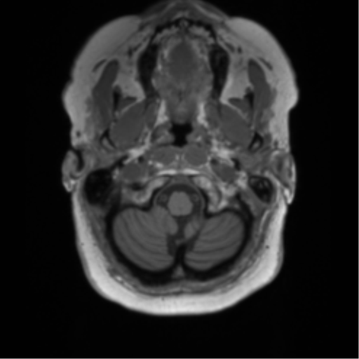 Anaplastic oligodendroglioma (Radiopaedia 83500-98599 Axial T1 9).png