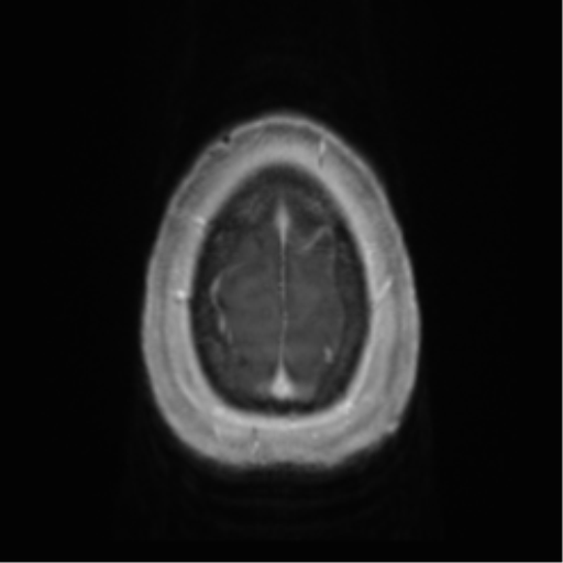 Anaplastic oligodendroglioma (Radiopaedia 83500-98599 Axial T1 C+ 71).png