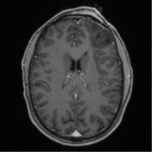 Anaplastic oligodendroglioma with skull fracture (Radiopaedia 74831-85845 Axial T1 C+ fat sat 38).png