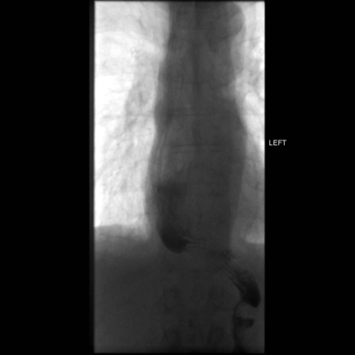 File:Anastomotic stricture post Ivor Lewis esophagectomy (Radiopaedia 47937-52715 C 16).png