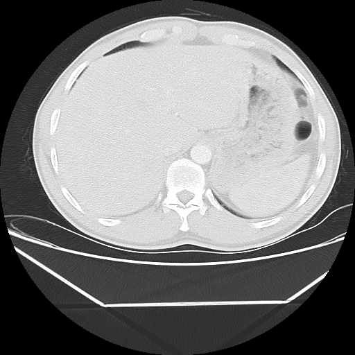 File:Aneurysmal bone cyst - rib (Radiopaedia 82167-96220 Axial lung window 57).jpg
