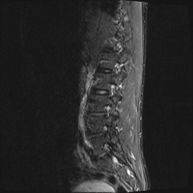 File:Aneurysmal bone cyst T11 (Radiopaedia 29294-29720 Sagittal STIR 4).jpg