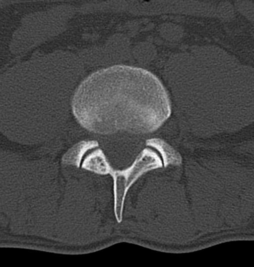 Aneurysmal bone cyst T11 (Radiopaedia 29294-29721 Axial bone window 104).jpg