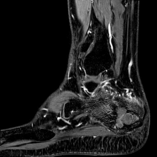 File:Aneurysmal bone cyst of the calcaneus (Radiopaedia 60669-68420 F 5).jpg
