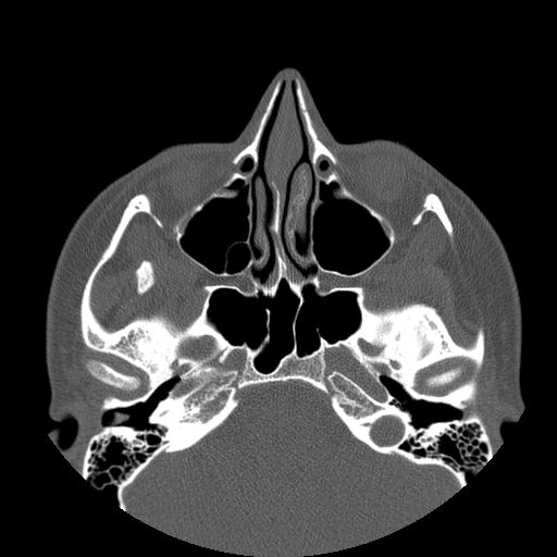 Aneurysmal bone cyst of the mandible (Radiopaedia 43280-46823 Axial bone window 147).jpg