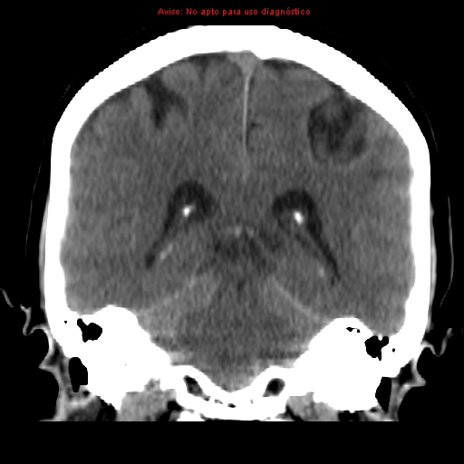 File:Aneurysmal subarachnoid hemorrhage (Radiopaedia 24740-24997 Coronal non-contrast 30).jpg
