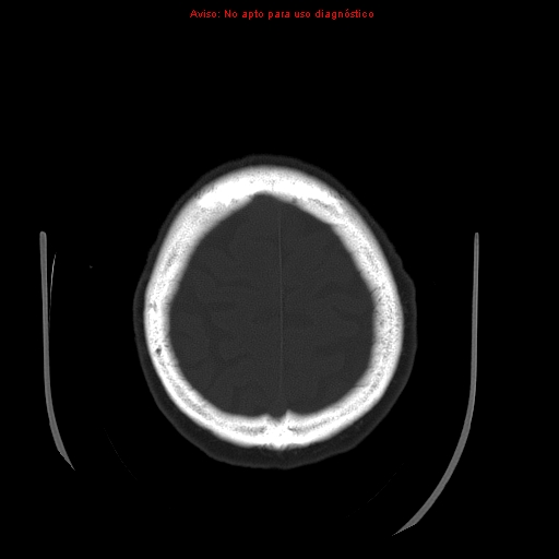File:Aneurysmal subarachnoid hemorrhage (Radiopaedia 24740-24997 bone window 31).jpg