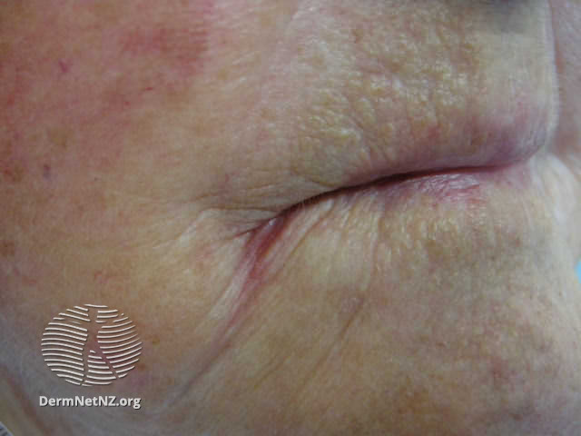 File:Angular cheilitis (DermNet NZ site-age-specific-perleche7).jpg
