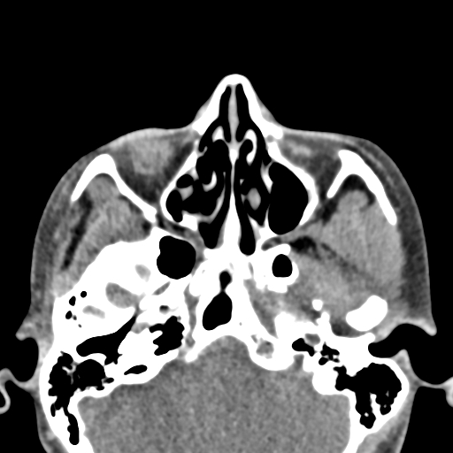 Angular dermoid cyst (Radiopaedia 88967-105790 Axial non-contrast 20).jpg