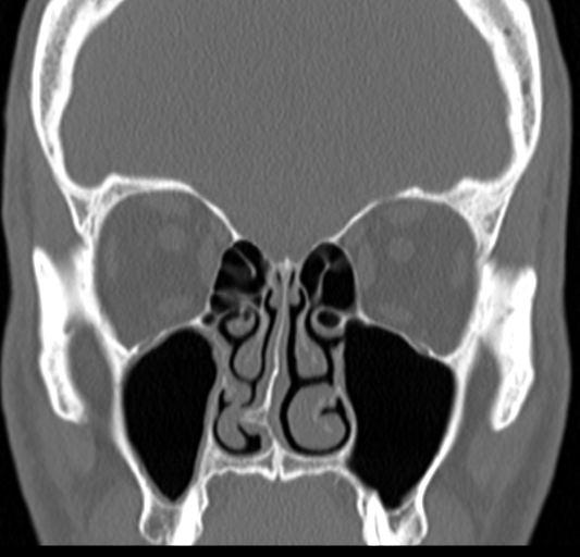 Angular epidermoid cyst (Radiopaedia 46908-51439 Coronal bone window 30).png