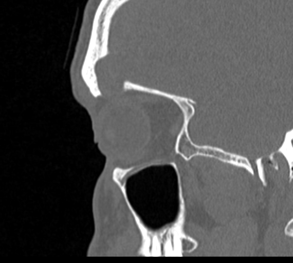 Angular epidermoid cyst (Radiopaedia 46908-51439 Sagittal bone window 73).png