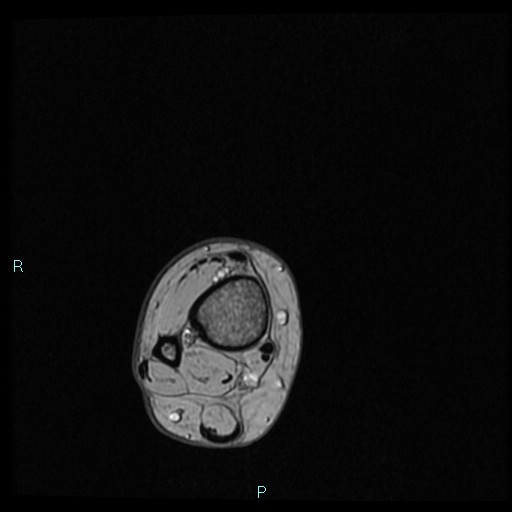 Ankle ganglion cyst (Radiopaedia 62809-71162 Axial Gradient Echo 97).jpg