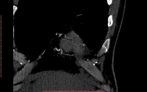 Anomalous left coronary artery from the pulmonary artery (ALCAPA) (Radiopaedia 70148-80181 B 40).jpg