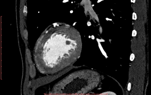 File:Anomalous left coronary artery from the pulmonary artery (ALCAPA) (Radiopaedia 70148-80181 C 202).jpg
