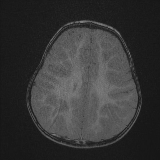 Anoxic brain injury (Radiopaedia 79165-92139 Axial MRA 179).jpg