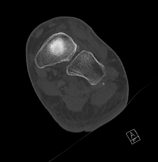 Anterior calcaneal process fracture (Radiopaedia 63353-71943 Axial bone window 87).jpg
