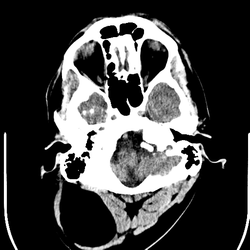File:Anterior cerebral artery territory infarct (Radiopaedia 39327-41581 Axial non-contrast 4).png