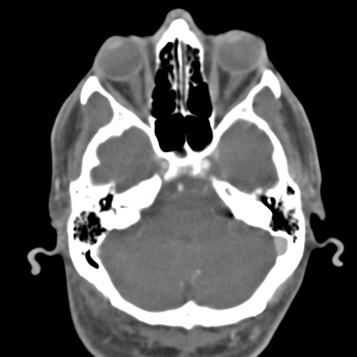 Anterior cerebral artery territory infarct (Radiopaedia 39327-41581 B 43).png