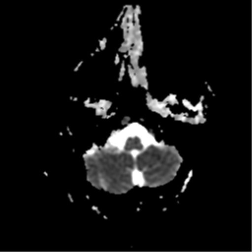 File:Anterior cerebral artery territory infarct (Radiopaedia 39327-41584 Axial ADC 3).png