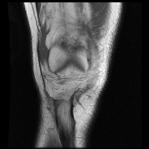 File:Anterior cruciate ligament avulsion fracture (Radiopaedia 58939-66193 Coronal T1 5).jpg