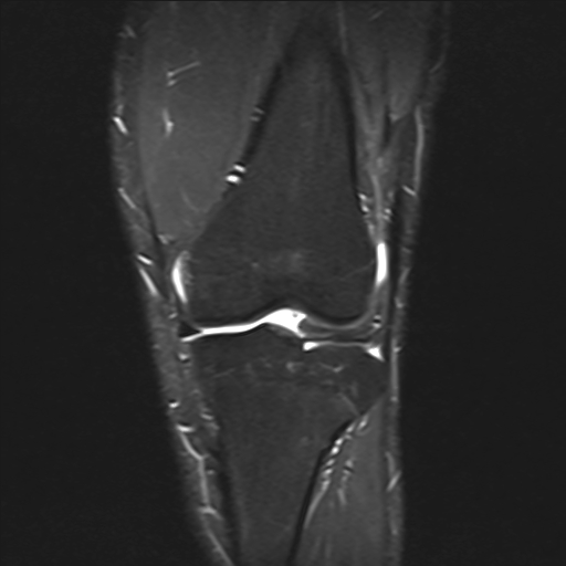 File:Anterior cruciate ligament full thickness tear (Radiopaedia 66268-75467 Coronal STIR 8).jpg
