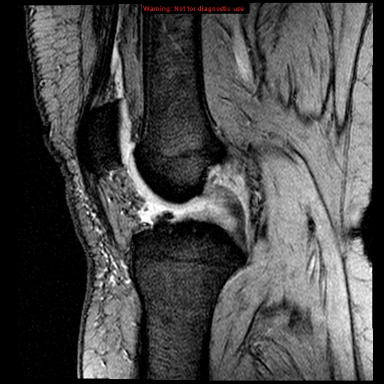 File:Anterior cruciate ligament tear (Radiopaedia 12329-12612 A 11).jpg