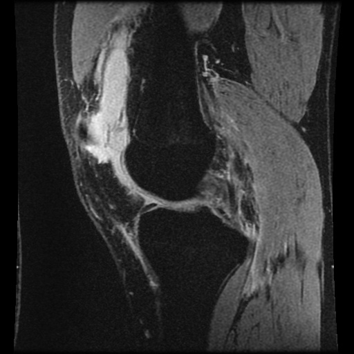 Anterior cruciate ligament tear (Radiopaedia 61500-69462 F 31).jpg