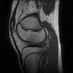 Anterior cruciate ligament tear - pediatric (Radiopaedia 62152-70260 Sagittal PD 121).jpg