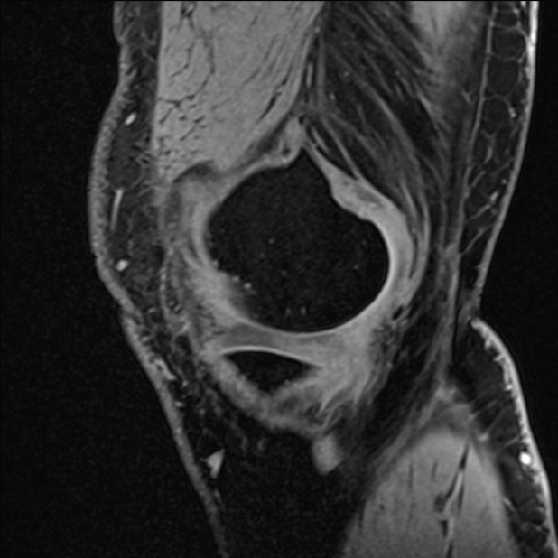 Anterior cruciate ligament tear - ramp lesion (Radiopaedia 71883-82322 Sagittal T1 vibe 117).jpg