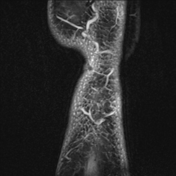 Anterior cruciate ligament tear - ramp lesion (Radiopaedia 71883-82322 Sagittal T1 vibe 4).jpg