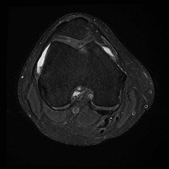 File:Anterior cruciate ligament tear with posteromedial corner injury, bucket-handle meniscal tear and chondral delamination (Radiopaedia 75501-86744 Axial PD fat sat 16).jpg