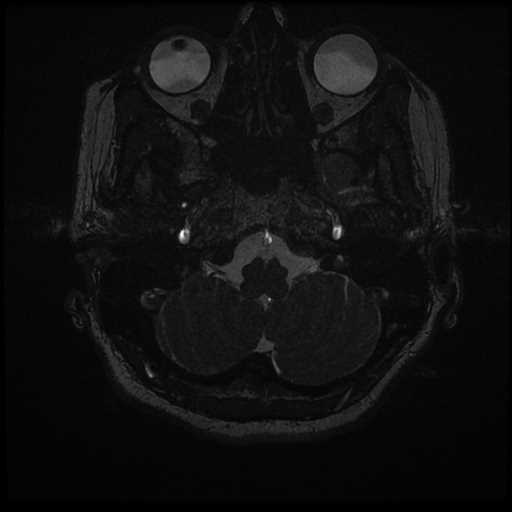 Anterior inferior cerebellar artery vascular loop - type II (Radiopaedia 70991-81209 Axial 3D FIESTA 67).jpg