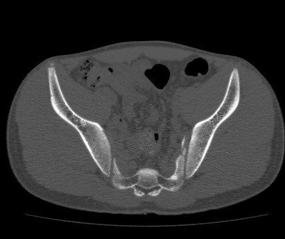 Anterior inferior iliac spine avulsion fracture (Radiopaedia 81312-94999 Axial bone window 36).jpg