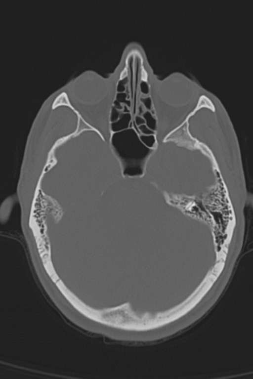 Anterior nasal spine fracture (Radiopaedia 46138-50494 Axial bone window 40).png