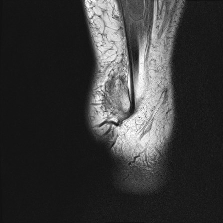 File:Anterior talofibular ligament injury - rupture with soft-tissue impingement (Radiopaedia 38765-40928 Sagittal PD 21).jpg