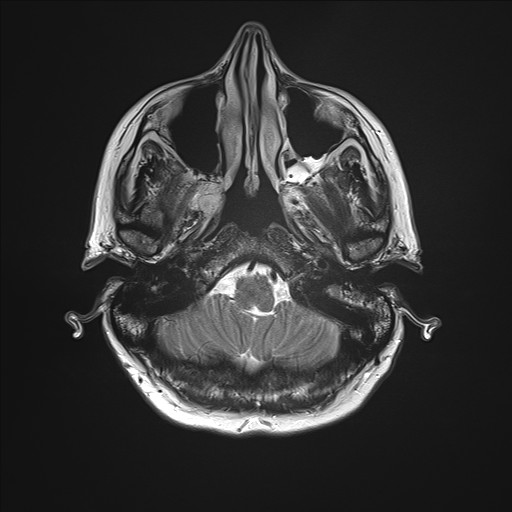 File:Anterior temporal encephalocele (Radiopaedia 82624-96808 Axial T2 4).jpg