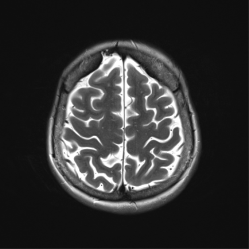 File:Anterior temporal lobe perivascular space (Radiopaedia 40946-43650 Axial T2 31).png